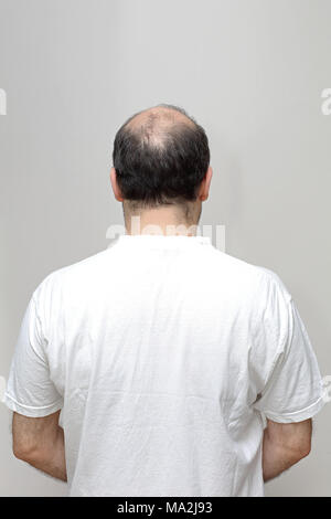 Vista posteriore della perdita dei capelli a mezza età uomo calvo Foto Stock