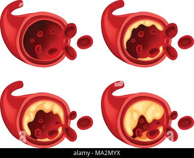 Diagramma che mostra il grasso nel sangue illustrazione Illustrazione Vettoriale