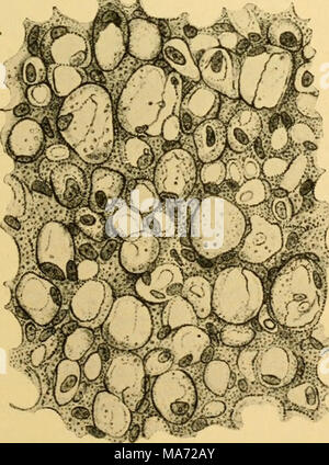 . Gli effetti di inanition e la malnutrizione al momento della crescita e struttura . Fig. 48.-tessuto adiposo dalla tela sub- cutanea di un emaciato, athreptic neonato. Cellule adipose inegualmente atrophied; alcune contengono ancora una quantità moderata di grassi in goccioline di dimensione variabile. I nuclei cellulari e citoplasma granulare evidente. X400. (Parrot '77). Foto Stock