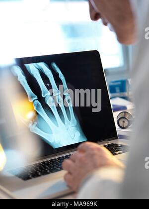 Modello rilasciato. Medico la visione a raggi X di una mano sullo schermo di un computer. Foto Stock