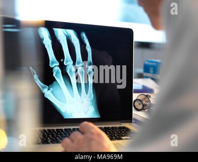 Modello rilasciato. Medico la visione a raggi X di una mano sullo schermo di un computer. Foto Stock