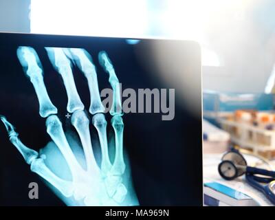 Modello rilasciato. Medico la visione a raggi X di una mano sullo schermo di un computer. Foto Stock