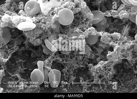 Le cellule rosse del sangue in una matrice fibrinosa sulla superficie luminale dell'inabitazione catetere vascolare ha rivelato nella scansione al microscopio elettronico (SEM) immagine, 2005. Immagine cortesia di centri per il controllo delle malattie (CDC) / Janice Haney Carr. () Foto Stock