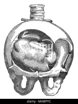 La posizione di un bambino in utero: posizione di spalla Foto Stock