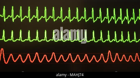 Il monitor mostra tachicardia sopraventricolare in verde e la pressione del sangue arterioso in rosso su sfondo nero. Foto Stock