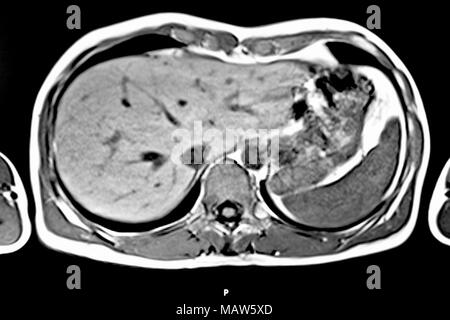 MRI scan dell umana torace e addome, vista trasversale. Ben riconoscibili sono il fegato, la milza e il midollo spinale Foto Stock