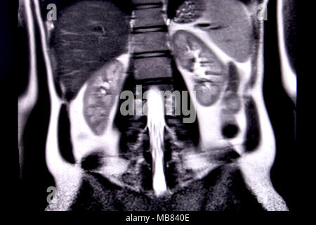 Viaggio attraverso l'addome umano e del torace mediante 18 tagli MRI (vista coronale). Immagine 11/18 Foto Stock