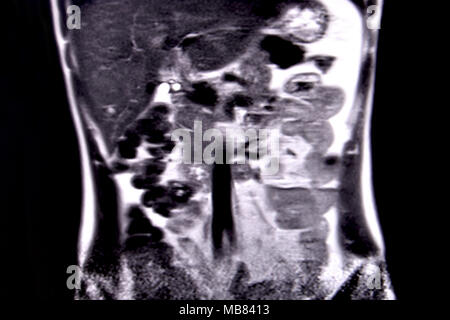 Viaggio attraverso l'addome umano e del torace mediante 18 tagli MRI (vista coronale). Immagine 2/18 Foto Stock