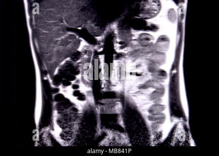 Viaggio attraverso l'addome umano e del torace mediante 18 tagli MRI (vista coronale). Immagine 4/18 Foto Stock