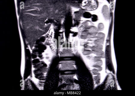 Viaggio attraverso l'addome umano e del torace mediante 18 tagli MRI (vista coronale). Immagine 5/18 Foto Stock