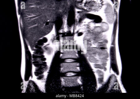 Viaggio attraverso l'addome umano e del torace mediante 18 tagli MRI (vista coronale). Immagine 6/18 Foto Stock