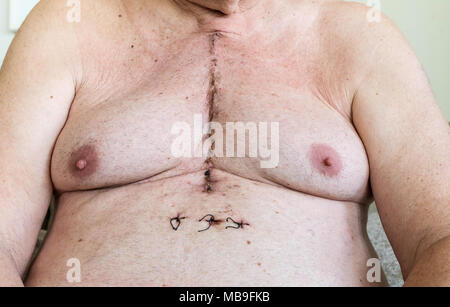 Scar dalla chirurgia a cuore aperto di malattia coronarica, dove lo sterno è stato tagliato in due e la gabbia della nervatura molleggiante. Al di sotto della cicatrice mostrano i fori dove th Foto Stock