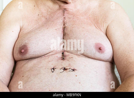 Scar dalla chirurgia a cuore aperto di malattia coronarica, dove lo sterno è stato tagliato in due e la gabbia della nervatura molleggiante. Al di sotto della cicatrice mostrano i fori dove th Foto Stock
