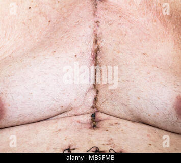 Scar dalla chirurgia a cuore aperto di malattia coronarica, dove lo sterno è stato tagliato in due e la gabbia della nervatura molleggiante. Al di sotto della cicatrice mostrano i fori dove th Foto Stock