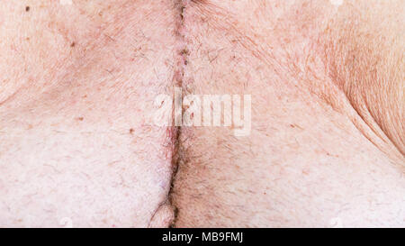 Scar dalla chirurgia a cuore aperto di malattia coronarica, dove lo sterno è stato tagliato in due e la gabbia della nervatura molleggiante. Al di sotto della cicatrice mostrano i fori dove th Foto Stock