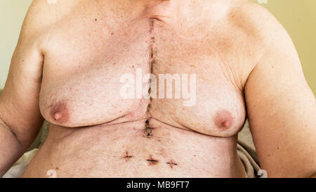 Scar dalla chirurgia a cuore aperto di malattia coronarica, dove lo sterno è stato tagliato in due e la gabbia della nervatura molleggiante. Al di sotto della cicatrice mostrano i fori dove th Foto Stock
