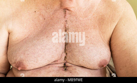 Scar dalla chirurgia a cuore aperto di malattia coronarica, dove lo sterno è stato tagliato in due e la gabbia della nervatura molleggiante. Al di sotto della cicatrice mostrano i fori dove th Foto Stock