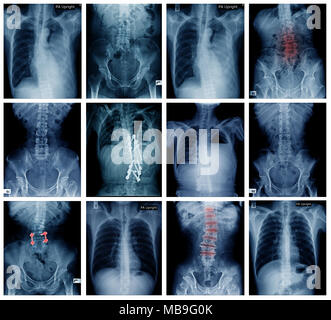Grande raccolta di back e pelvico x-ray, alta qualità setof x-ray Foto Stock