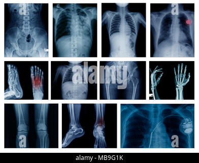 Alta collezione di qualità immagine a raggi x mostrano molti della parte di corpo di umana Foto Stock