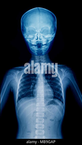 X-ray bambino la parte superiore del corpo, con altezza di film di qualità di bambino Foto Stock