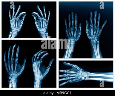 Mano di raccolta x-ray immagine ad alta qualità Foto Stock