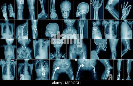 Alta qualità x-ray collezione parte del corpo e l'area di frattura Foto Stock