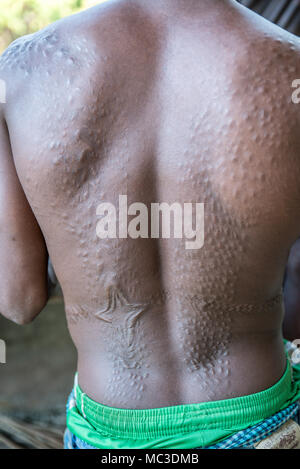 Cicatrici sulla schiena di un uomo Chambri a guardare come pelle di coccodrillo, Kanganaman village, Medio Sepik, Papua Nuova Guinea Foto Stock