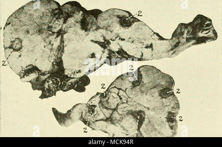. Fig. 46. Lipoma del grasso mesenterica di intestino crasso. La mucca. //,/, Lar^e intestino ; 2, 2, 2 sezioni trasversali delle anse di intestino crasso, circondato da tumore di grasso. Foto Stock