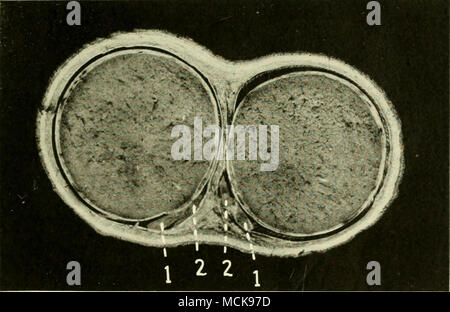 . Fig. 3 sezione trasversale attraverso lo scroto e testicoli di vitello. /, /, Hody di epididimo ; .?, 2, vas deferens sul lato anteriore del mesorchiuin. epididimo, seguita da il corpo e anche la testa, passa attraverso l'anello, il testicolo gira sul suo asse trasversale, e la sua testa diventa incarcerato nel anello inguinale, la sua estremità caudale rimanendo nell'addome. Il inexperi- enced chirurgo tenta di castrate il cryptorchid, en- contatori epididimo nella sacca peritoneale e am- putates dal testicolo sotto l'impressione che egli è castrare l animale. Più tardi un sec Foto Stock