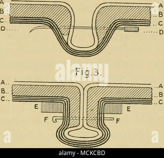 . Fig. 222.-Schema illustrante Degive del funzionamento per il cordone ombelicale e ventrale di recidive. Un, sierosa; B, muscolo- aponeurotic, e C, cappotti cutaneo dell'ernia; D, l'ago speciale in luogo ; EE, vongole ; FF, chiodi. Le tre figure mostrano bhe fasi successive dell'operazione. Ernia acquisite. Acquisite o hernise accidentali non sono gravi e solo meritano di essere studiati nella misura in cui incidono sugli organi contenuti nella cavità addominale. Essi possono risultare dalla violenza, o può avvenire senza intervento di qualsiasi causa esterna. Recidive traumatica può verificarsi in qualsiasi punto della parete addominale Foto Stock