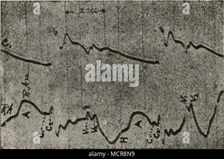 . Fig. 85. Kammer- und Vorhofdruckkurve vom Hund. Nach Piper. Von rechts nach links zu lesen. Mit diesen Kurven die stimmen von v. Zwaluvenburg und Agnew^ aufgenom- menen Kurven der Vorhofkontraktion nahe überein (vgl. Fig. 86). Auch hier finden wir nach der Ersten Erhebung bei der Vor- hofsystole eine mehr oder weniger bedeutende Senkung, welche von ein paar neuen Erhebungen, unter denen die zweite (Cg) dem Anfang der Kammersystole entspricht, unterbrochen wird. Dann folgt eine neue, flüchtige Drucksenkung; der darauf einsetzende Anstieg ist wieder in zwei Gipfeln gespaltet; der erste würde n Foto Stock