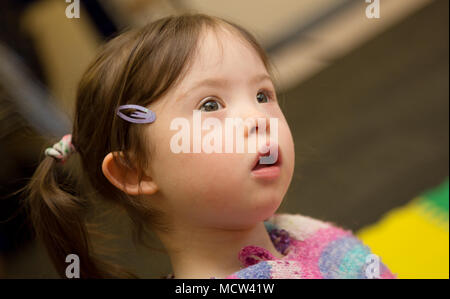 Bambina con sindrome di Downs Foto Stock