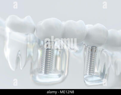 Impianti con ponte dentale - 3d rendering Foto Stock