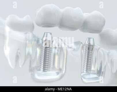 Impianti con ponte dentale - 3d rendering Foto Stock