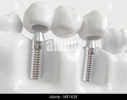 Impianti con ponte dentale - 3d rendering Foto Stock