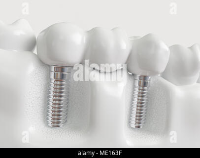 Impianti con ponte dentale - 3d rendering Foto Stock