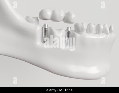 Impianti con ponte dentale - 3d rendering Foto Stock