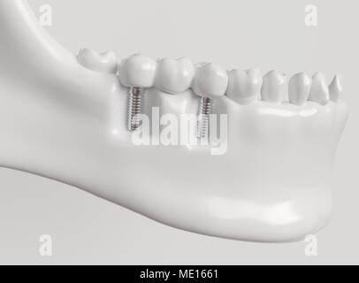 Impianti con ponte dentale - 3d rendering Foto Stock