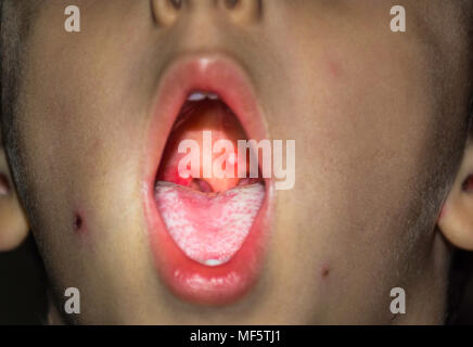 Immagine ravvicinata di virus della varicella o varicella bolla rash e brufoli all'interno della bocca del bambino sul palato molle. Dermatologia concetto. Foto Stock
