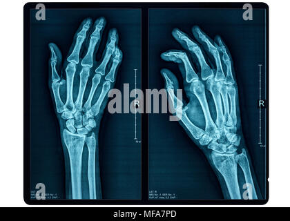 Mano X-ray di una femmina adulta Foto Stock