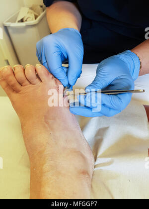 Un infermiere con blu guanti chirurgici rimuove maglie dai pazienti il piede destro e tre settimane dopo una chirurgia bunion. Foto Stock