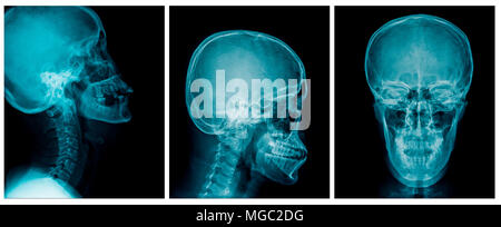 Cranio di raccolta x-ray e colonna vertebrale cervicale vista laterale Foto Stock