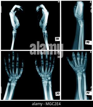 Raccolta di immagini a raggi x, mano x-ray AP e vista laterl Foto Stock