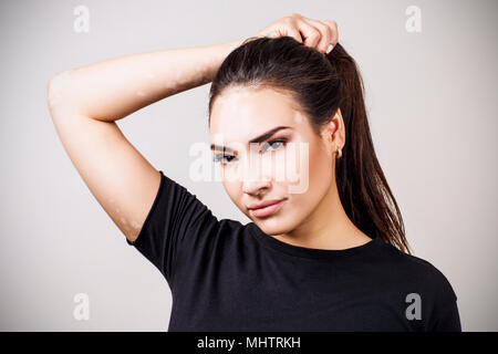 Ritratto di donna bella con la vitiligine in black t-shirt. Foto Stock