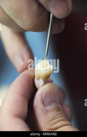 Dente artificiale che viene svolto da una protesi dentaria specialista. Foto Stock