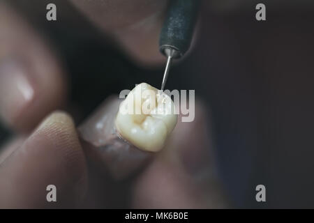 Dente artificiale che viene svolto da una protesi dentaria specialista. Foto Stock