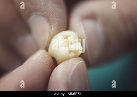 Dente artificiale che viene svolto da una protesi dentaria specialista. Foto Stock