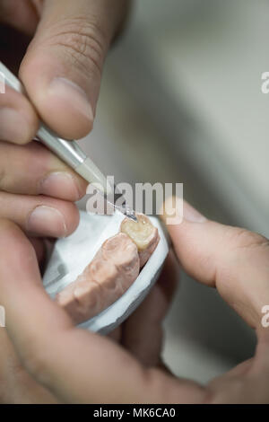 Dente artificiale che viene svolto da una protesi dentaria specialista. Foto Stock