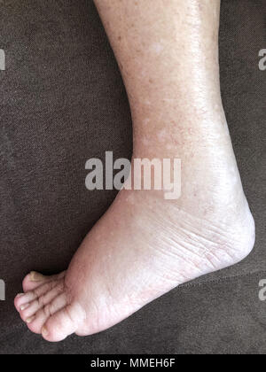 Primo piano del piede femminile malato paziente che soffre di malattia di edema Foto Stock