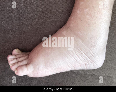Primo piano del piede femminile malato paziente che soffre di malattia di edema Foto Stock